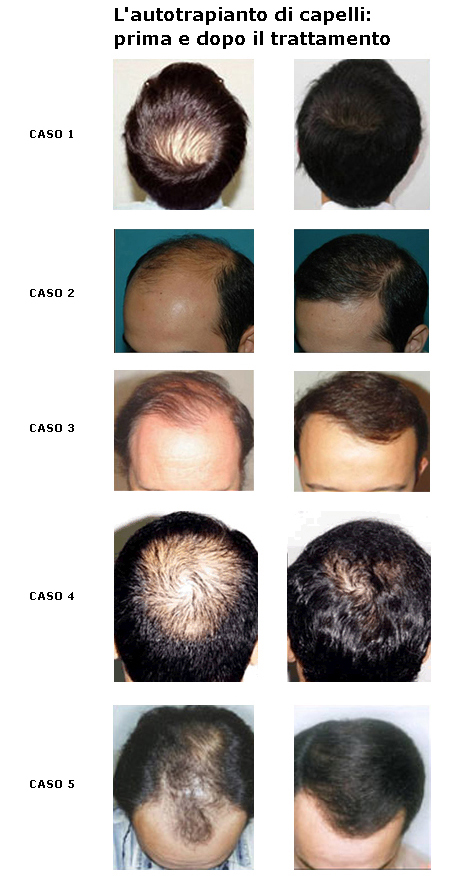 Questo tipo di trattamento consente di portare i capelli a lunghezze. Autotrapianto Capelli: Prima e Dopo