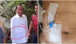 Tak Hanya Wajah, Perut Jokowi Juga Disorot Saat Acara Ulang Tahun, Dokter Tifa Duga Itu Alat CAPD
