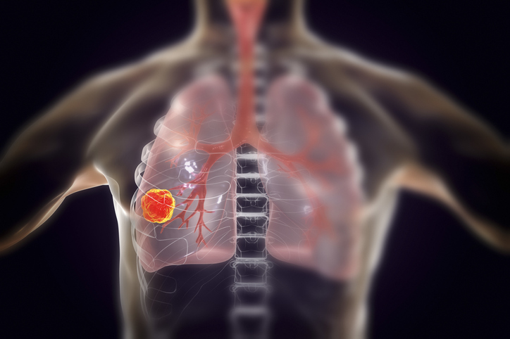 AI & FLIM Detect Lung Cancer Mutations Without Genetic Testing | 96.6% Accuracy (2026)