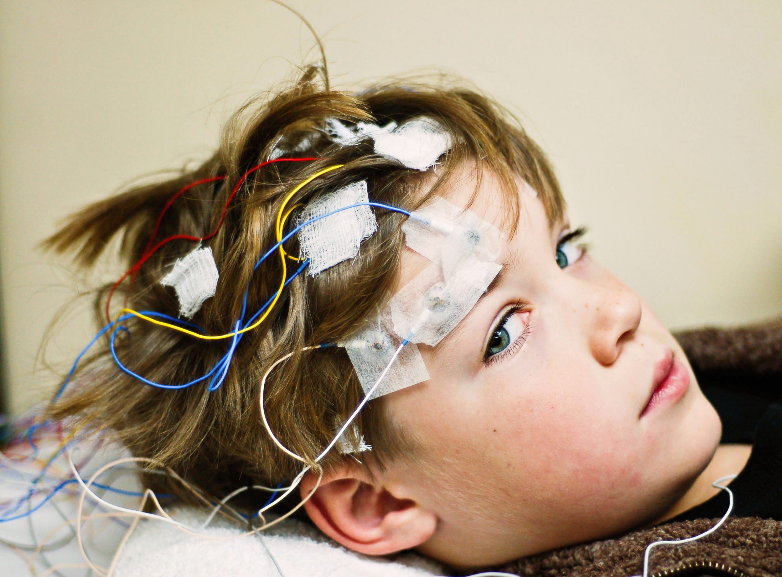 Personalized Therapy: How ASOs Revolutionize Treatment for Rare Epilepsy Syndrome (2026)