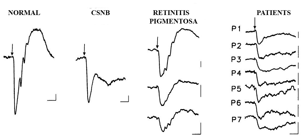 18+ Beautiful Is Blindness Hereditary : About this Disease - Color Blindness - Roman, roll up or decorative, learn the tricks to choosing blinds for your home.