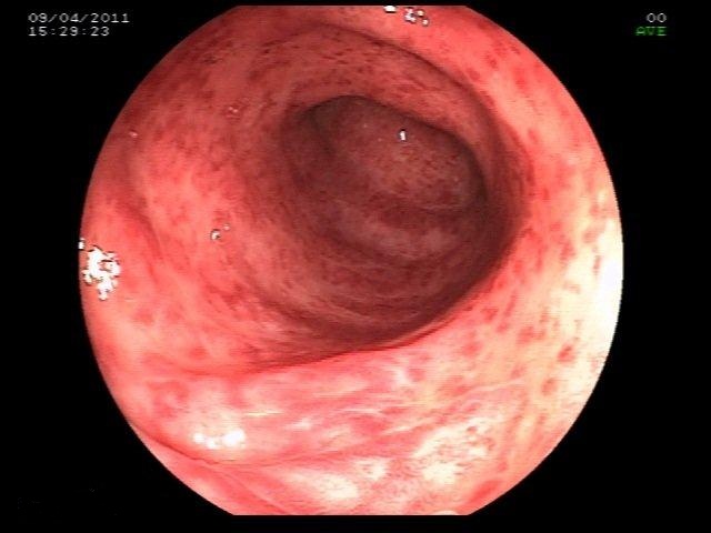 images Ulcerative Colitis Colonoscopy intechopen