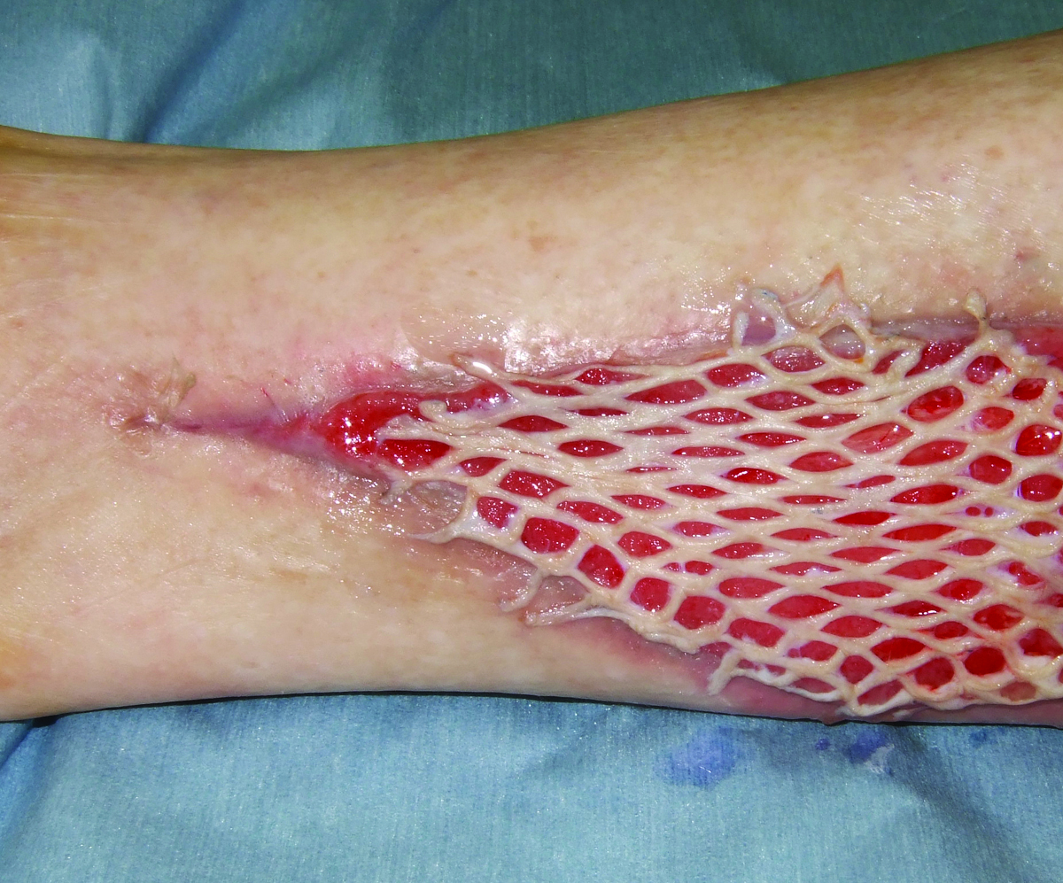 pics Skin Grafting intechopen