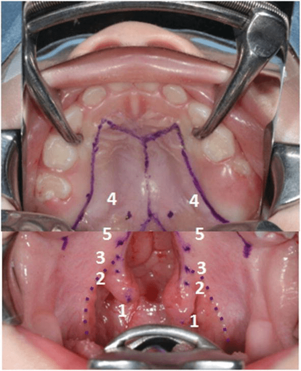 A plastic surgeon will repair the baby's cleft lip first, usually when the baby is about 3 months old. Surgical Strategy Of Cleft Palate Repair And Nasometric Results Intechopen