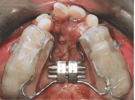 Educate and support family for . Cleft Lip And Palate Patients Diagnosis And Treatment Intechopen