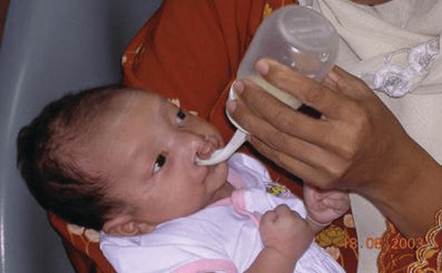 These associated conditions include 'pierre robin sequence' (prs), stickler syndrome and 22q11 deletion syndrome. Cleft Lip And Palate Management From Birth To Adulthood An Overview Intechopen