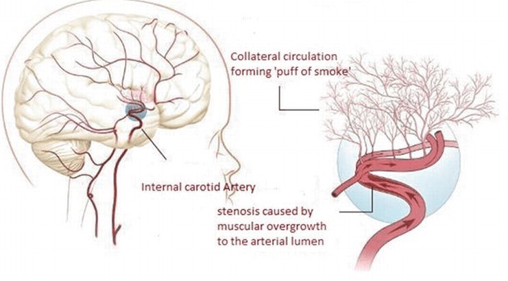 The central nervous system is made up of the brain and spinal cord. Moyamoya Disease A Rare Vascular Disease Of The Cns Intechopen