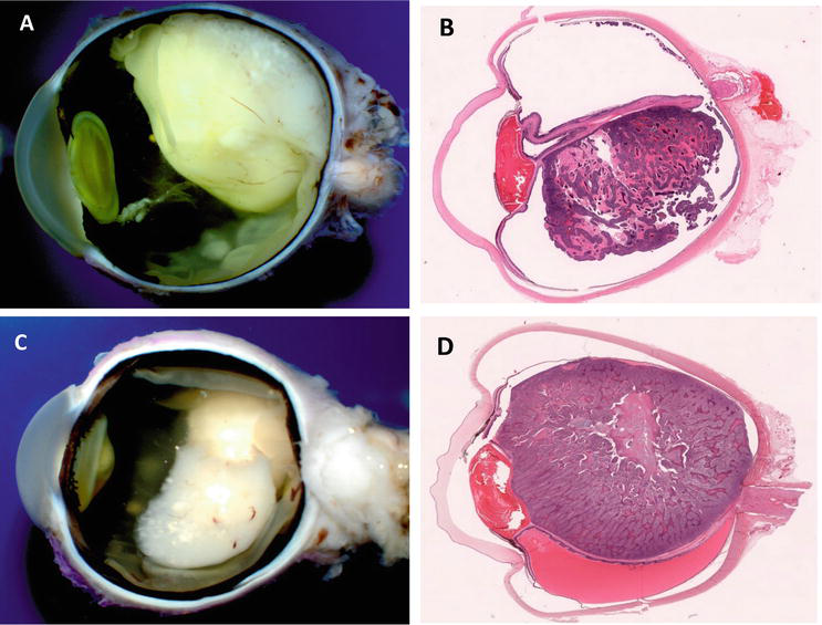 Fleurettes Retinoblastoma Histology : Histopathological Characteristics And Classification For Prognostic Indicators Intechopen