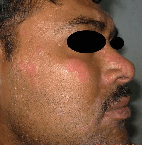 pix Sarcoidosis Skin Bumps intechopen