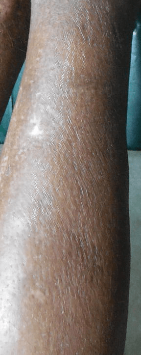 pix Sarcoidosis Skin Lesions clinical manifestations of sarcoidosis and granulomatous disorders intechopen