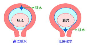高位破水感染 高位破水で感染癥が心配です Aypsaf