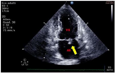 Il Ruolo Dell'ecocardioscopia Nella Diagnosi Precoce Di Masse Cardiache E Pseudomasse In Pronto Soccorso – Itjem 256_x_406_jpg
