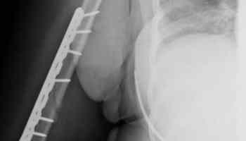 Plate and screws in humerus (upper arm bone)