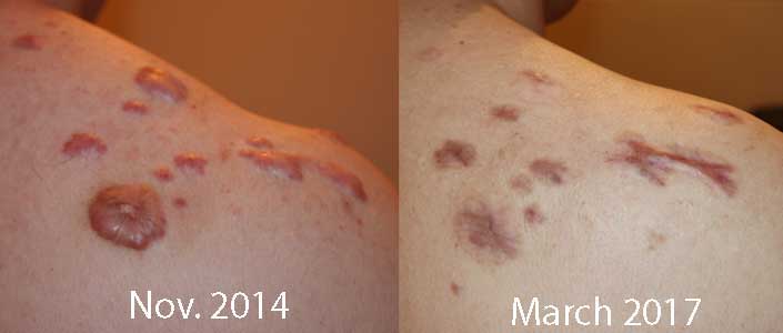 Apply on a daily basis for few weeks and the scars will disappear. Keloid Specialist, Keloid Removal Expert, Keloid Treatment