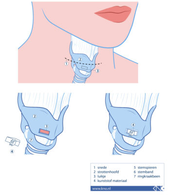 Thyreoplastiek - Keel-Neus-Oorheelkunde en Heelkunde van het Hoofd-Halsgebied (1) Thyreoplastiek - Keel-Neus-Oorheelkunde en Heelkunde van het Hoofd-Halsgebied (1)