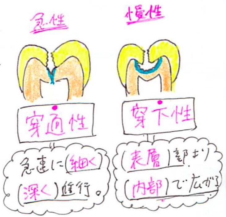 下穿