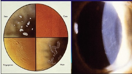 Most Common Corneal Dystrophy Map Dot Fingerprint Dystrophy Lee 