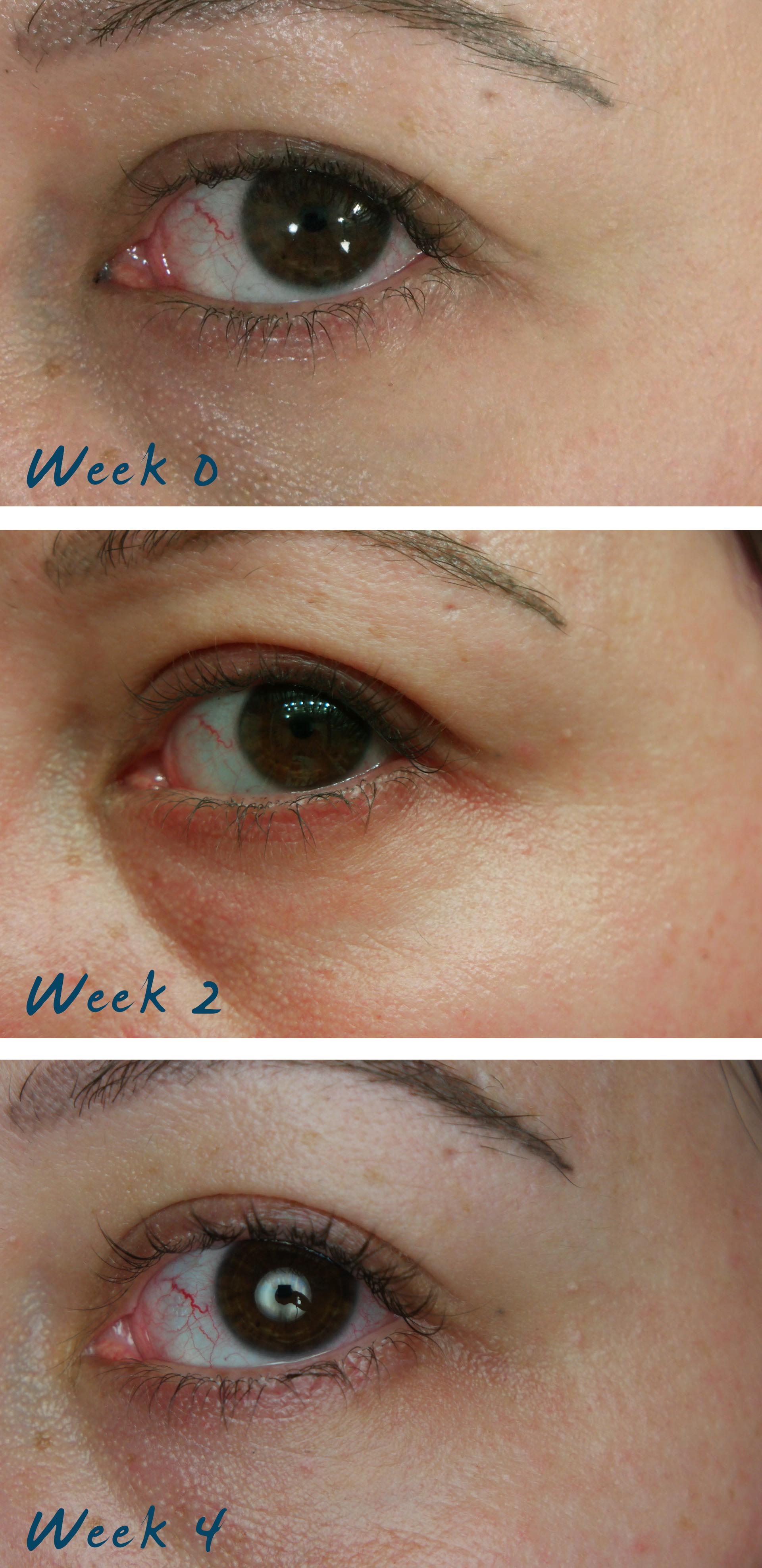 Tria Eye Wrinkle Correcting Laser Review Part 1 Lipstick Latitude