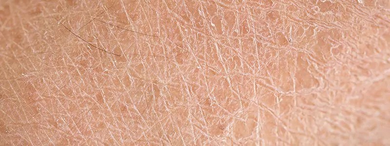dry skin