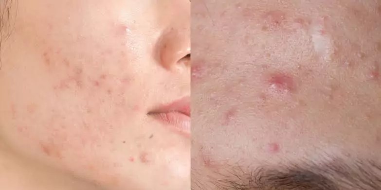 ADULT ACNE