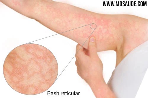 Parvovirus Reticlar Rash ERITEMA INFECCIOSO – PARVOVÍRUS B19 – Espaço de José Marcos- DOENÇAS ...