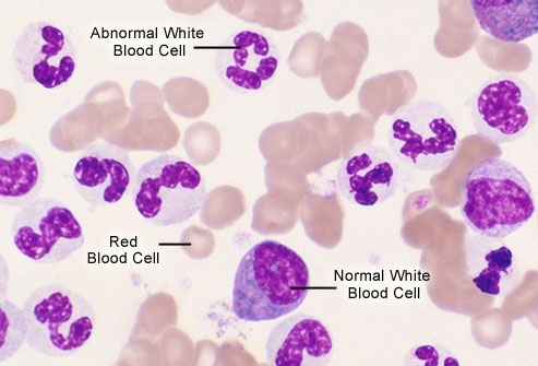 Chronic myeloid leukemia