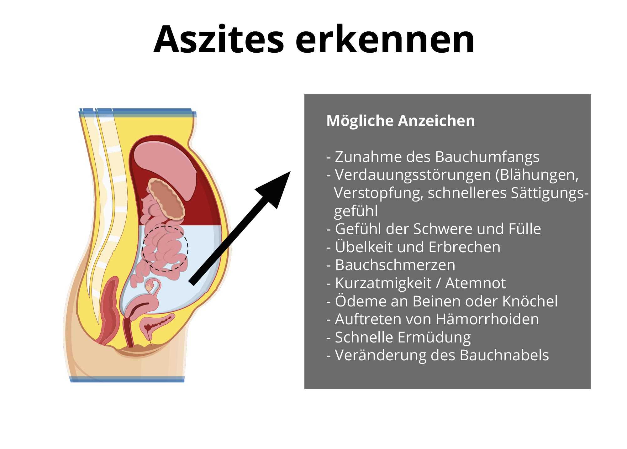 images Wasser Im Bauchraum medpertise