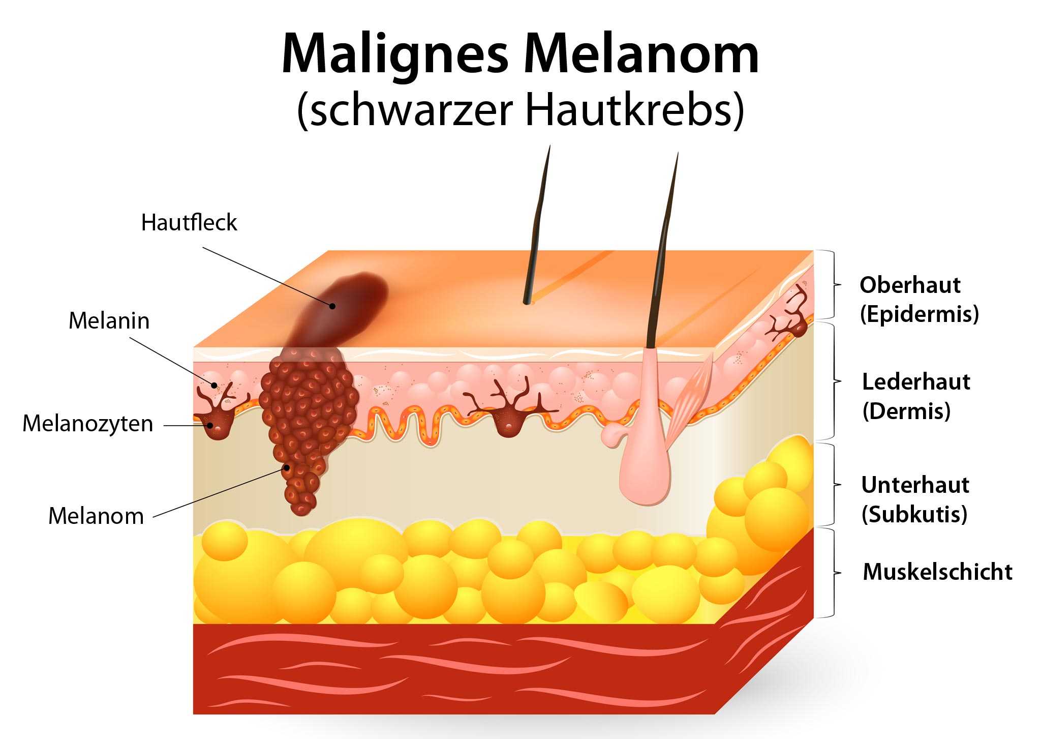 Das maligne melanom ist ein aggressiver, von den melanozyten ausgehender tumor der haut. Hautkrebs Malignes Melanom