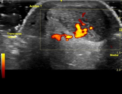 Achilles tendinopathy with Power Doppler signal indicating severe mid-portion tendinopathy