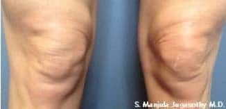 After Fraxel for Knees