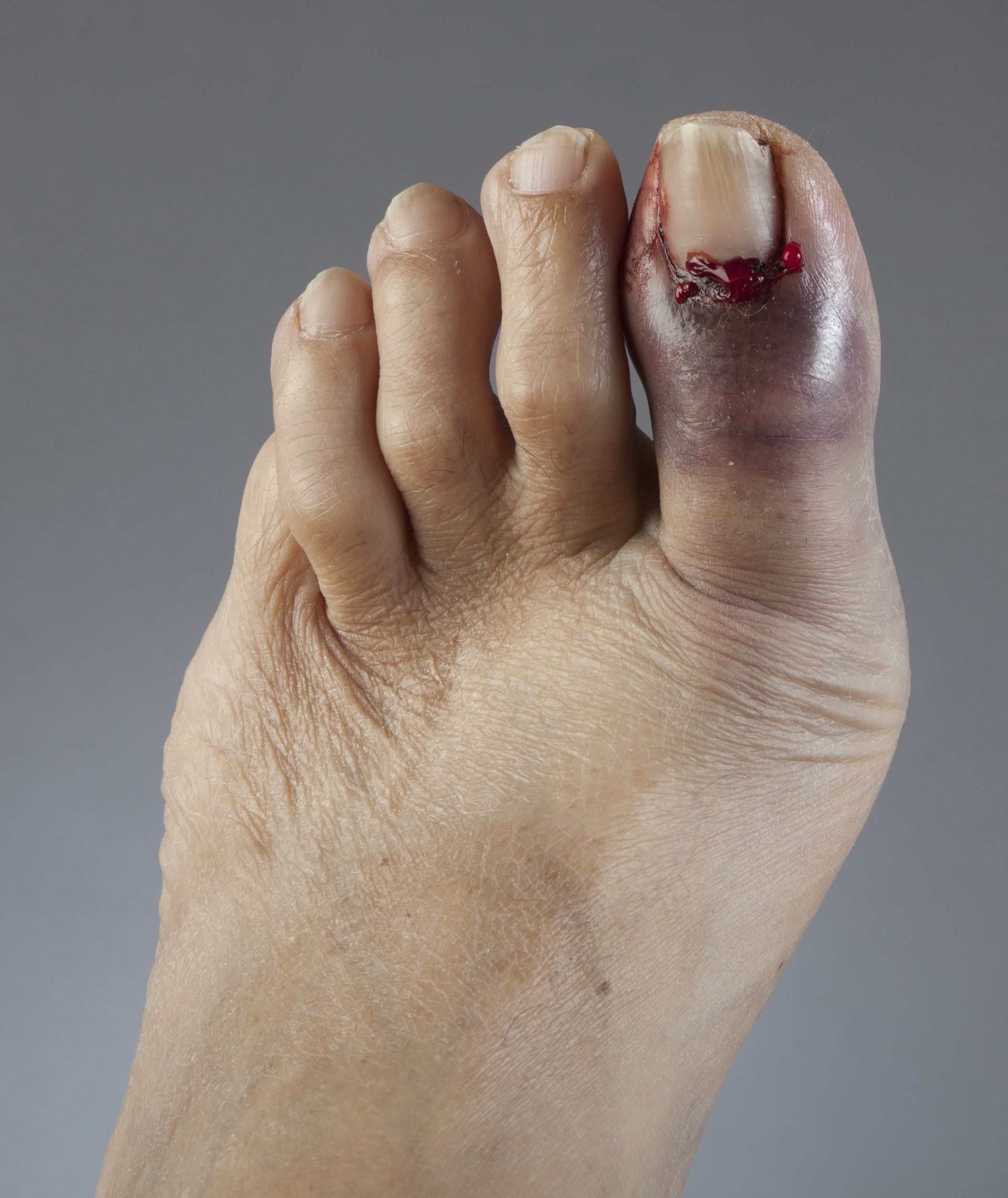 Anyone Ridden W/ A Broken Big Toe? - Training - Trainerroad