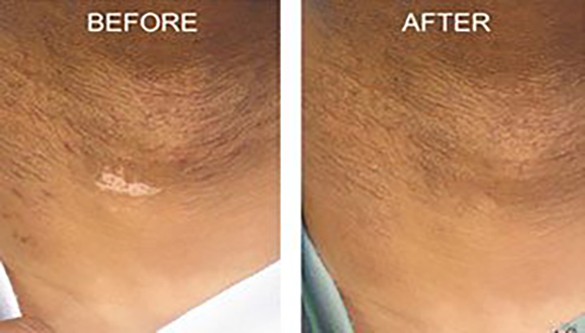 Scar Treatment By Microart Semi Permanent Makeup Camouflages Scars