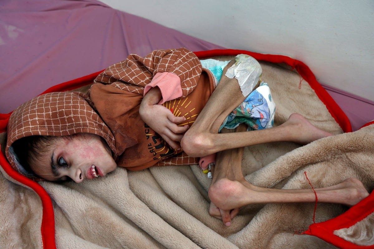 Faid Samim, a 7-year-old boy receives treatment at hospital in Sanaa, Yemen on 29 December 2020 [Mohammed Hamoud/Getty Images]