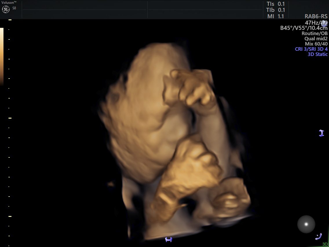 صورة جنين على رباعي الأبعاد