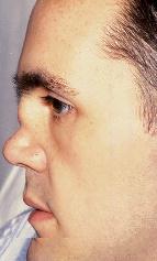 Because the skull cannot expand perpendicular to the fused suture, it compensates by growing more in the direction parallel to the closed sutures. relapsing polychondritis