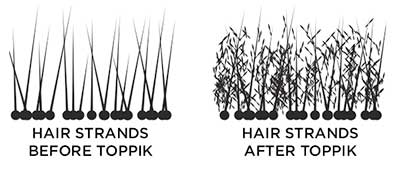 Toppik side effects propecia