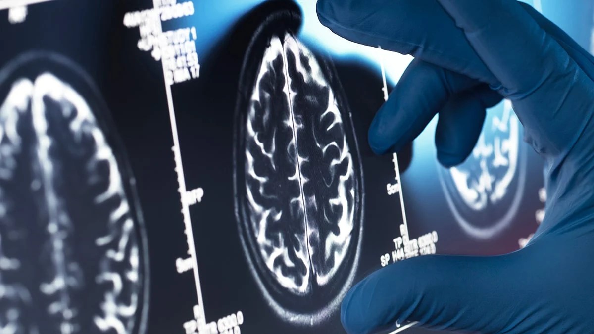 Alzheimer's Disease Threat May Emerge From Beyond The Brain, Study Finds