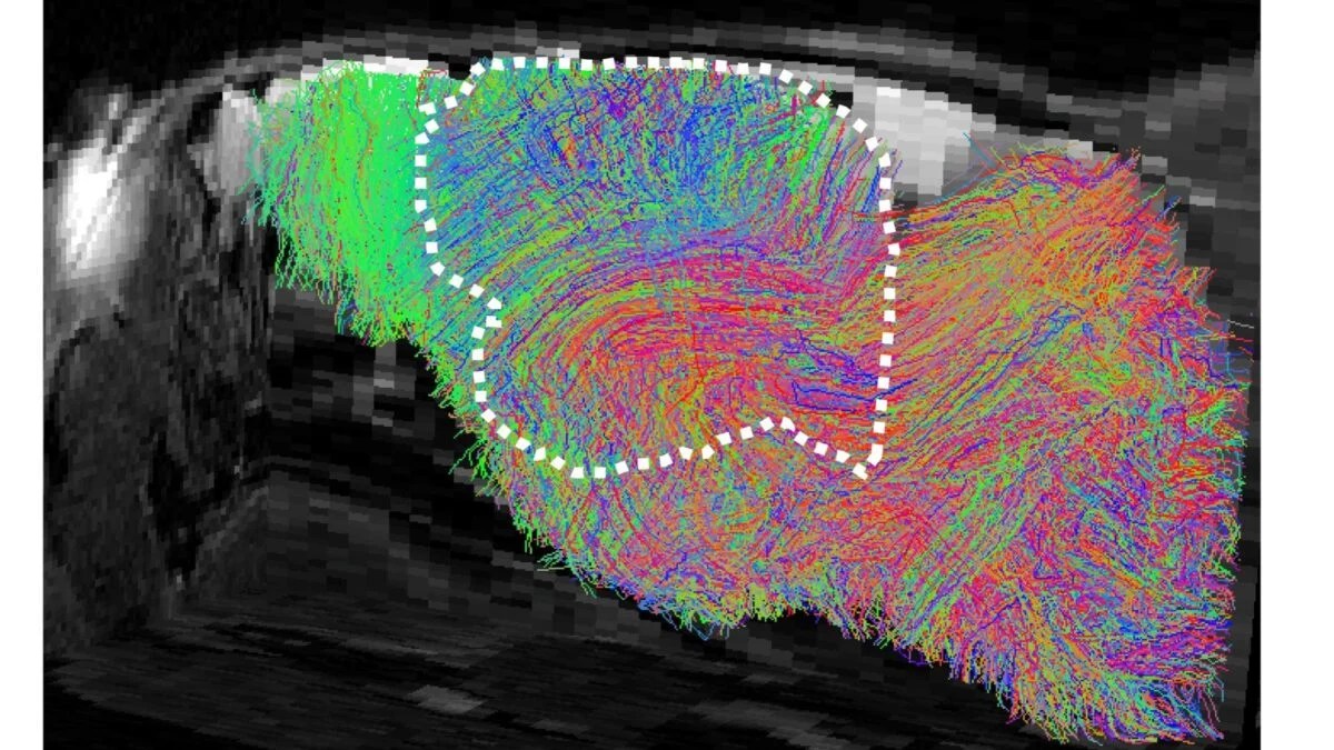 Stanford Researchers Grow Human Brain Organoids Inside Mice