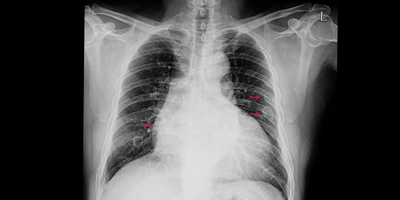 Help broken ribs heal faster