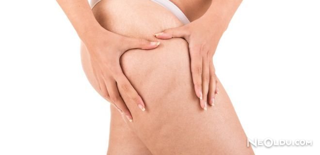 Selulit Nedir Selulit Tedavisi Nasil Olur Selulit Nasil Gecer Oku Haber Tarafsiz Haber Oku