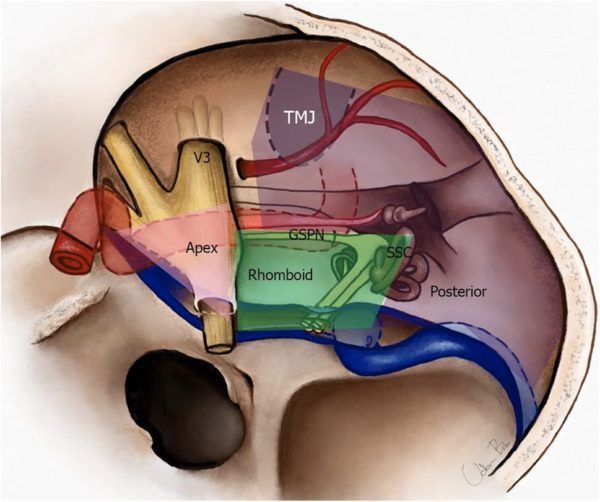 The Microsurgical Approaches… surgical approaches – Neurosurgery Blog