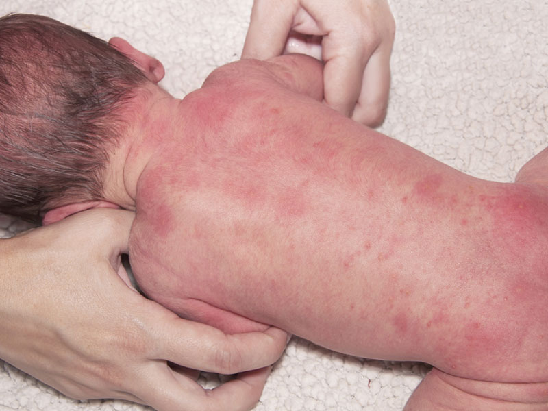 Comment traiter l&rsquo;eczéma du nourrisson ?