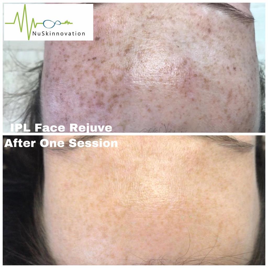 Laser treatment for freckles