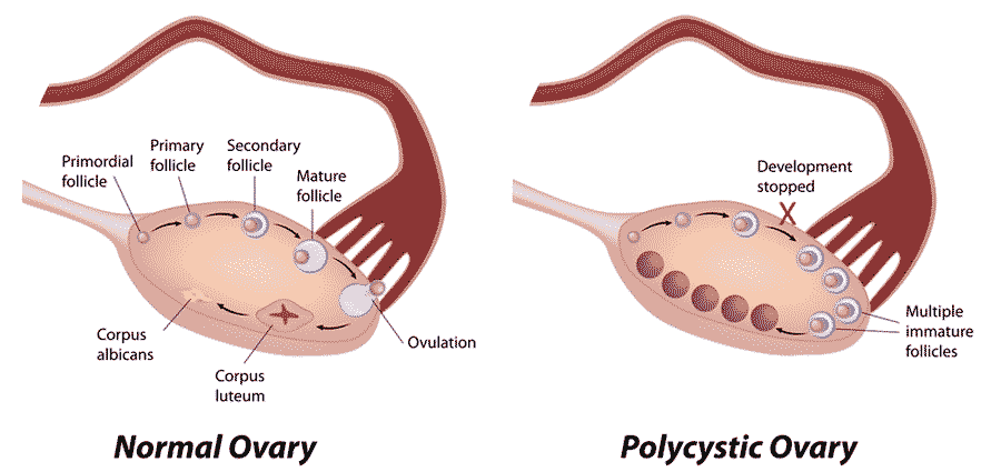 PCOS-labeled-web