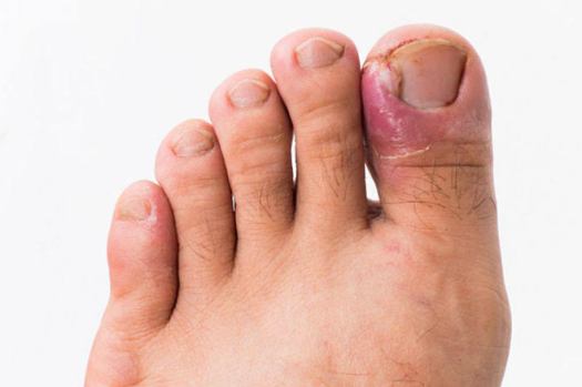 Klinik Dermatoloji 24 Tırnak Batması. Batık Tırnak Tedavi. Dermatolog Dr. Orhan Demirer Dermatoloji Kliniği, Alsancak, İzmir