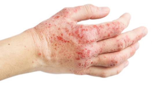Klinik Dermatoloji 2 Elde Kontak Dermatit - Egzama
