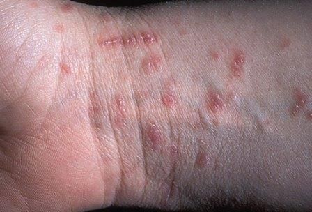 Klinik Dermatoloji 26 Uyuz Hastalığı (Skabiyez)