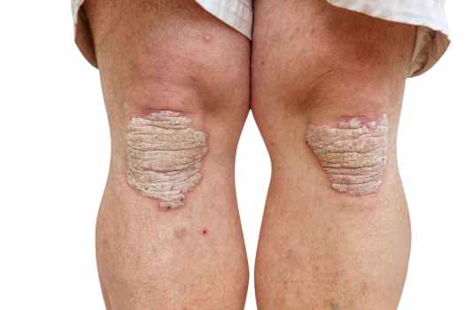 Klinik Dermatoloji 22 Psoriazis (Sedef Hastalığı)