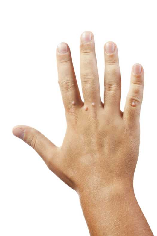 Klinik Dermatoloji 23 Lazerle siğil tedavisi