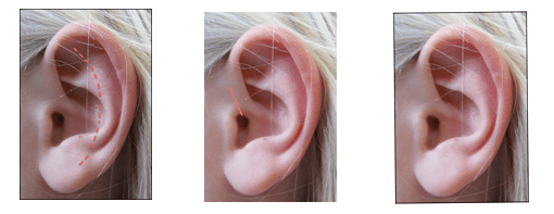 Typam Perfore Opération Du Tympan : Causes, Symptômes, Déroulement – AVXVI